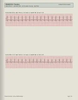 ECG readout, page 11